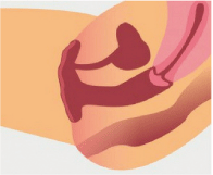 Vergrößerte Vagina