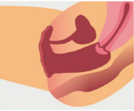 Vergrößerte Vagina